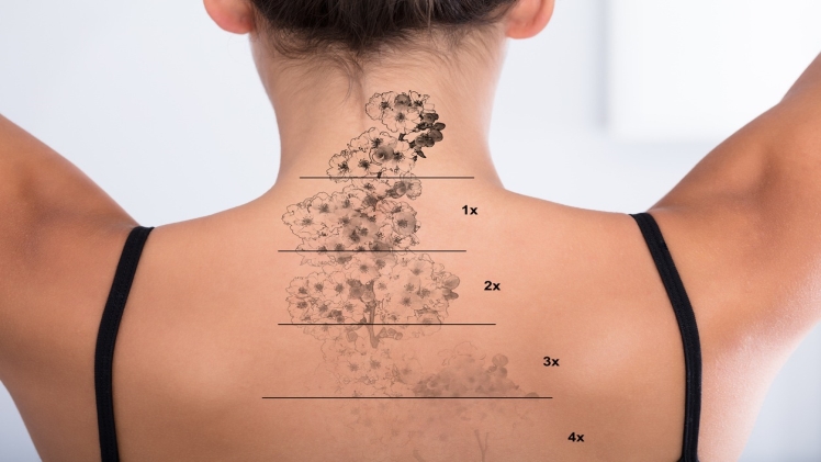 How to Choose a Tattoo Removal Clinic Is a Significant Decision - Techy Bio